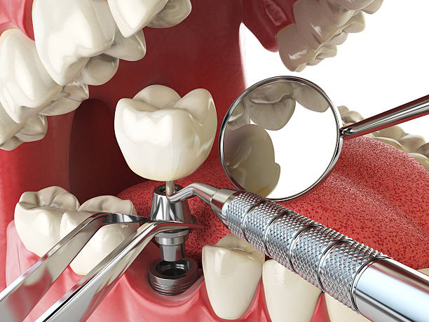 Best Emergency Root Canal Treatment in Richland, MO